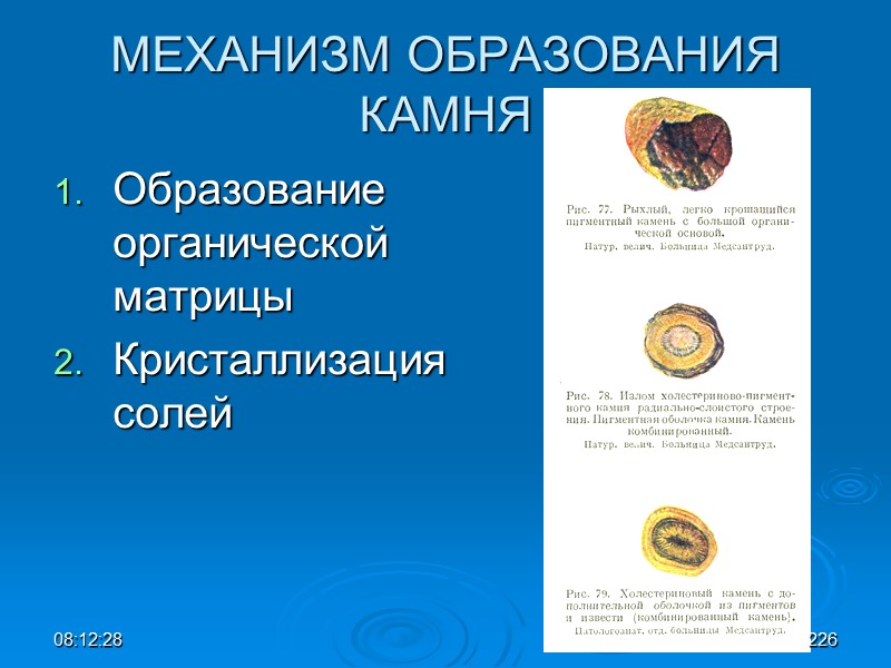 08:12:02 МЕХАНИЗМ ОБРАЗОВАНИЯ КАМНЯ Образование органической матрицы Кристаллизация солей 226